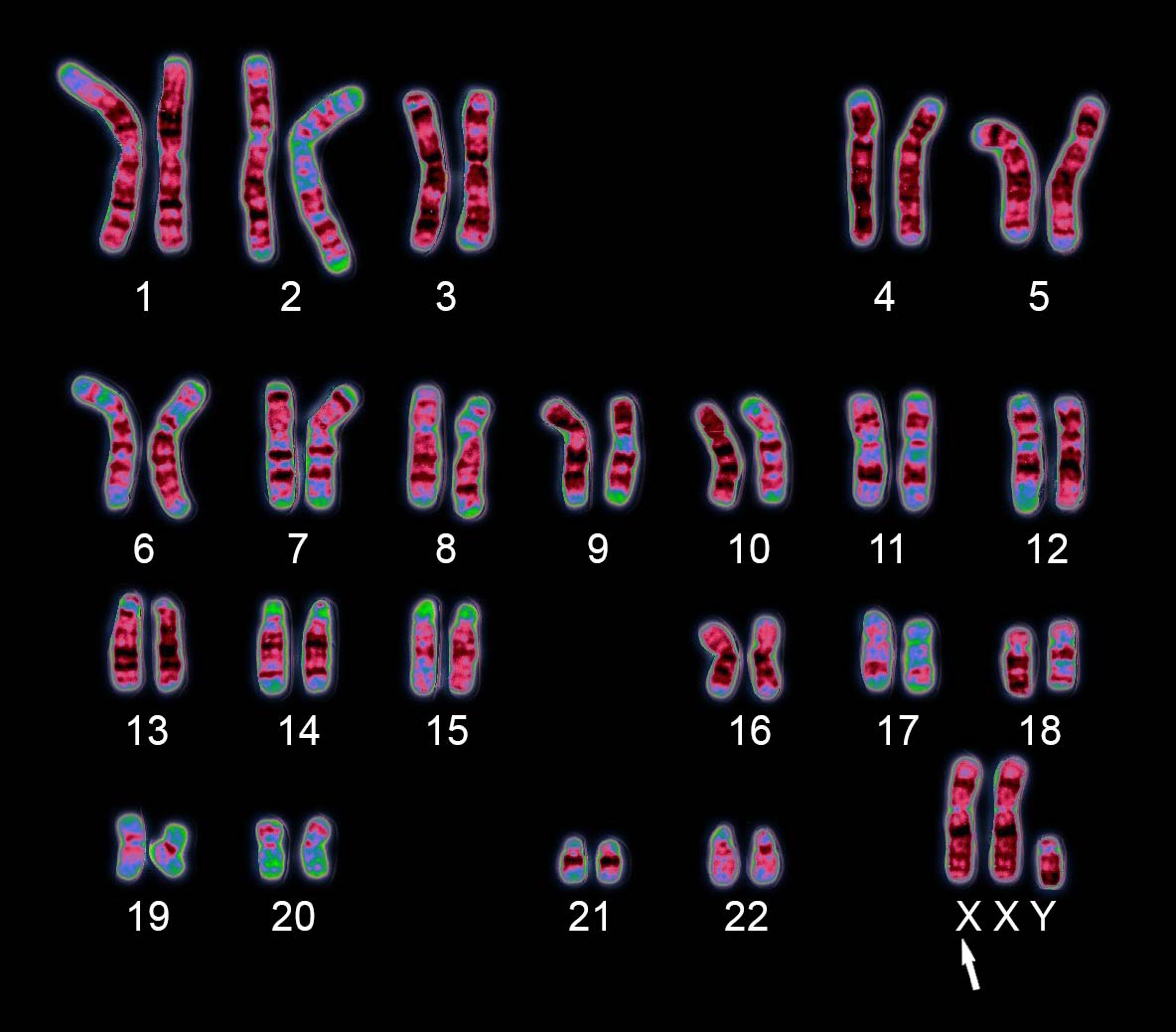 Klinefelter Syndrome A Rare Genetic Disease That Affects Males That