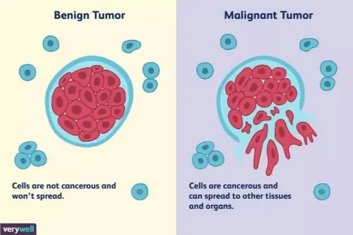 Differences between benign and malignant