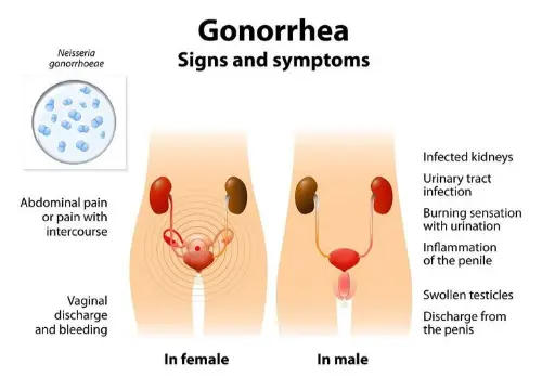 Gonorrhea symptoms