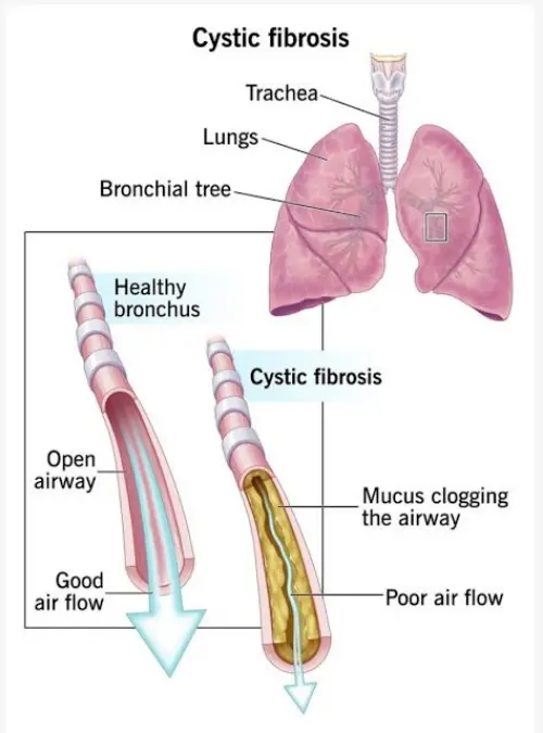Cystic Fibrosis anatomy