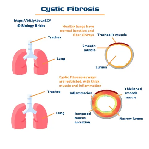 Cystic Fibrosis explanation