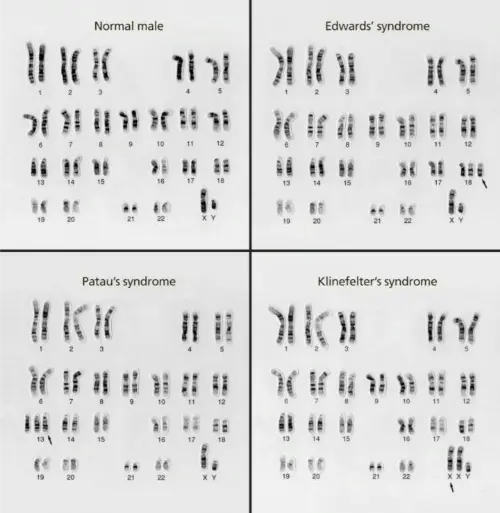 Disorder karyotypes