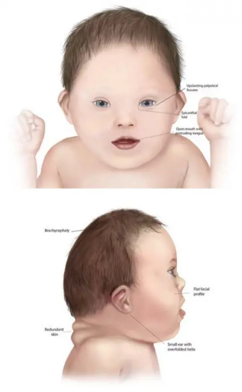 Down's syndrome anatomy