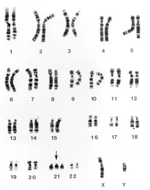 Down's syndrome karyotype