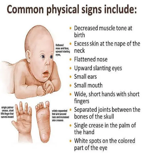 Symptoms of Down's syndrome