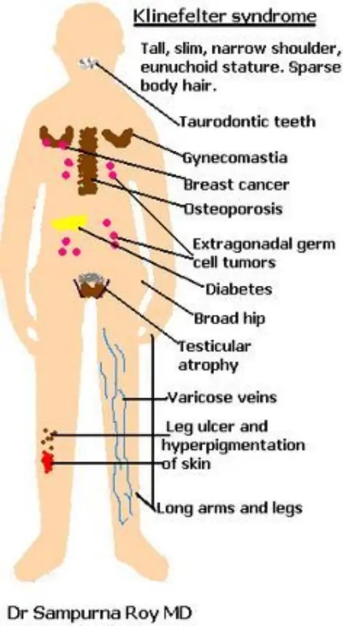 Klinefelter anatomy