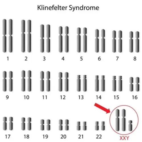 Klinefelter karyotype