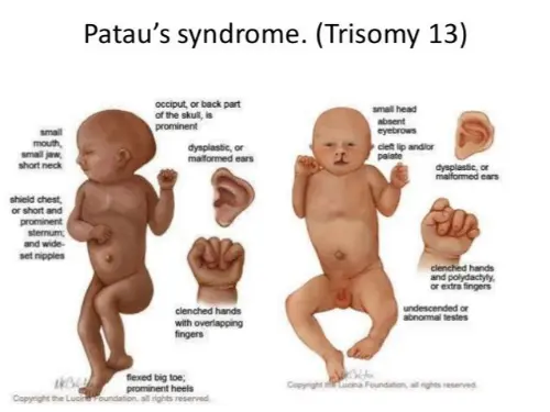 Patau anatomy