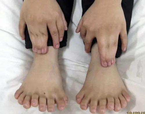 Polydactyly in hands and feet