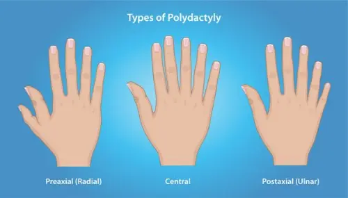 Types of Polydactyly