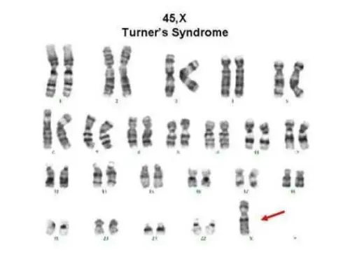 Turner syndrome karyotype