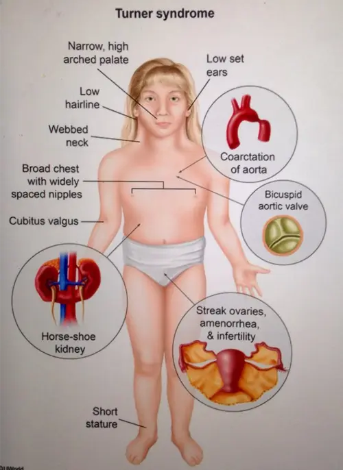 Turner syndrome anatomy