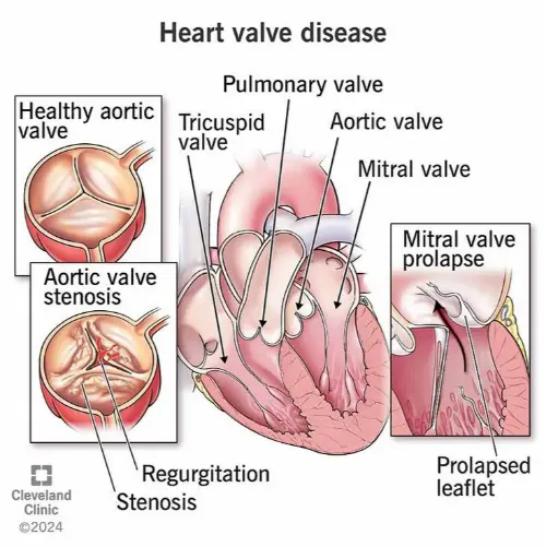 Valvular heart disease