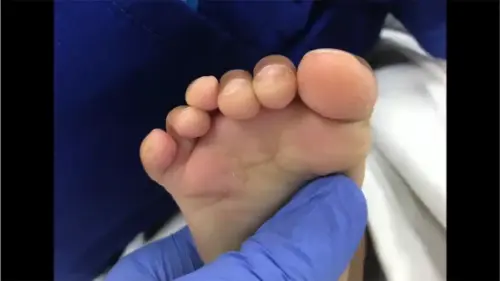 Watch this video from Paediatric Foot and Ankle on YouTube